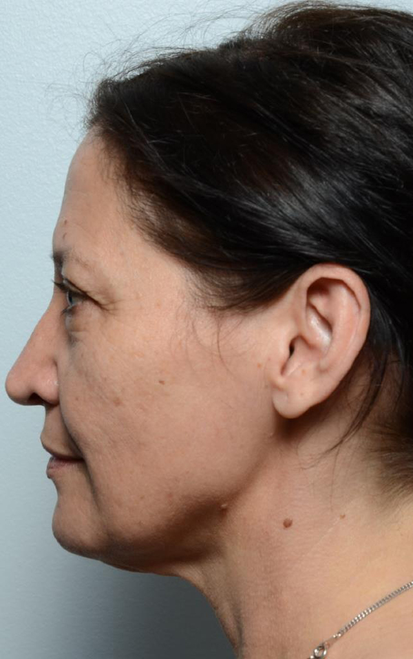 facelift-necklift Before