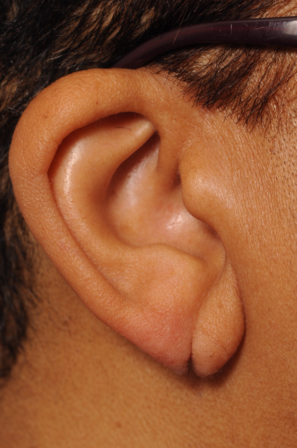 earlobe-repair Before