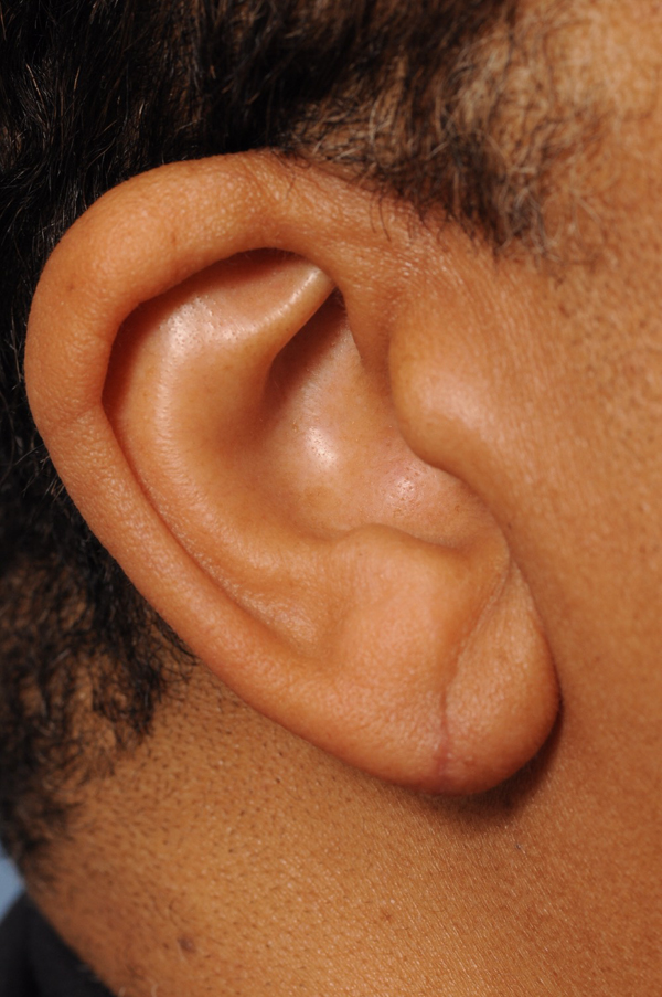 earlobe-repair After