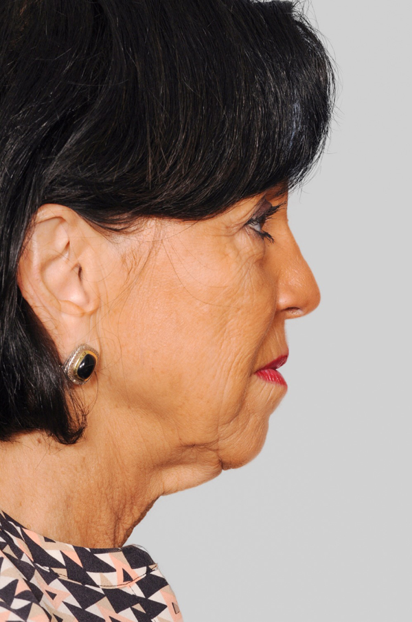 chin-augmentation Before