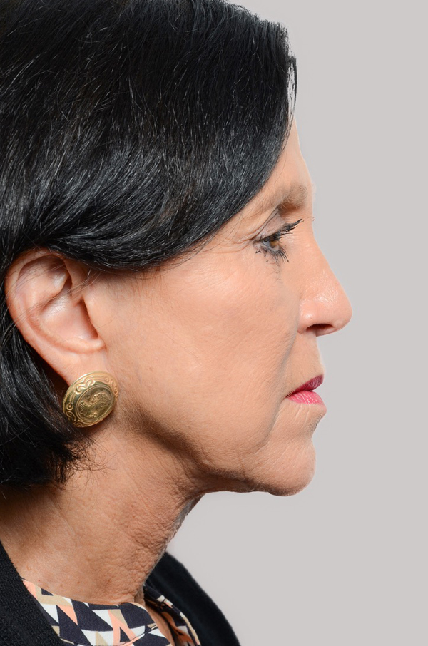 chin-augmentation After