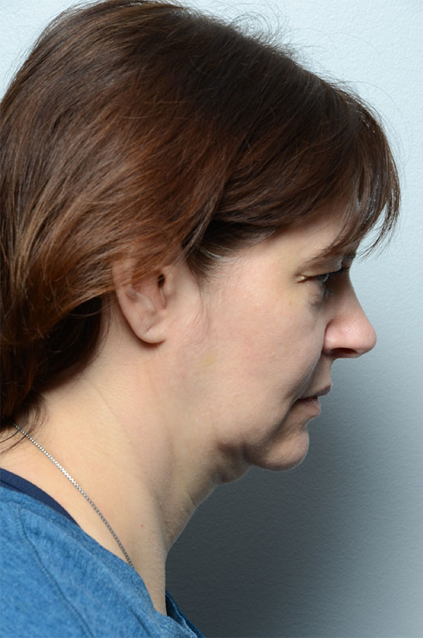 Before Skin Tightening Profile View of Woman's Face