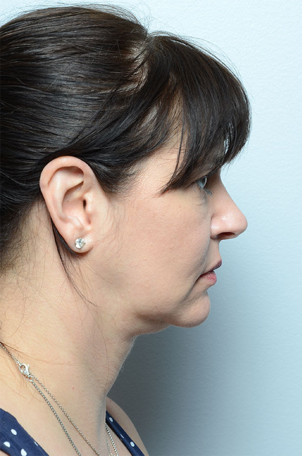After Skin Tightening Profile View of Woman's Face