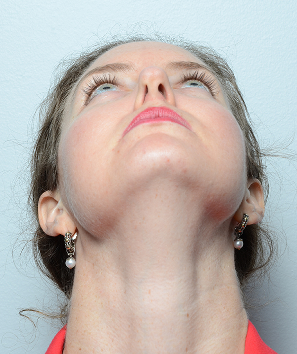 Rhinoplasty Baltimore and Towson